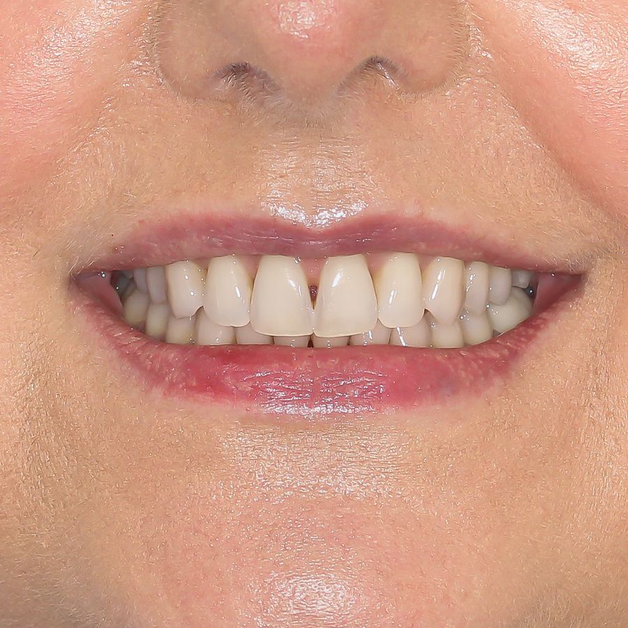 composite veneers before 3Dental